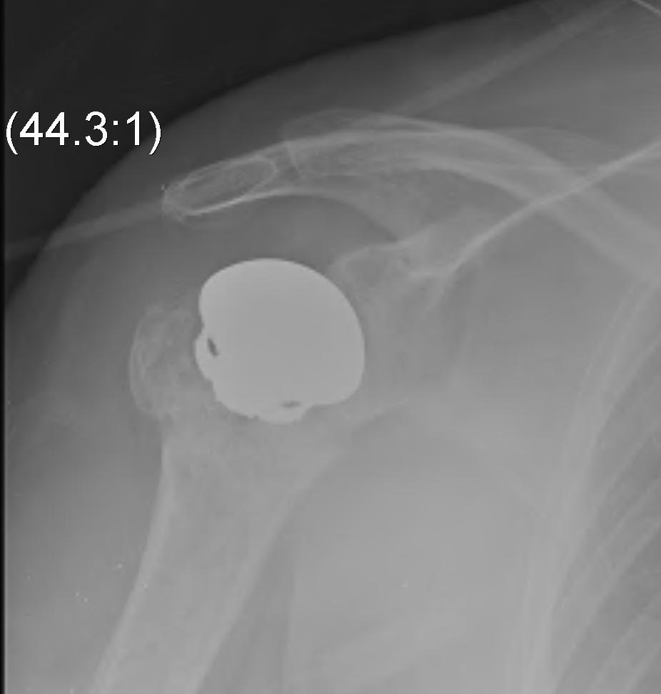 Shoulder Anatomical Hemiarthroplasty